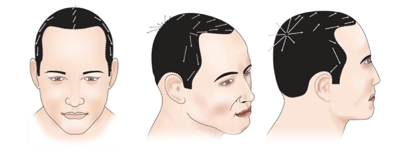 Direction and Angle of Hairline Varies from Head Side to Front