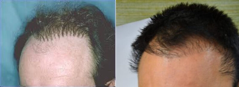 Fotos von zwei Köpfen mit Zickzack-Haartransplantation