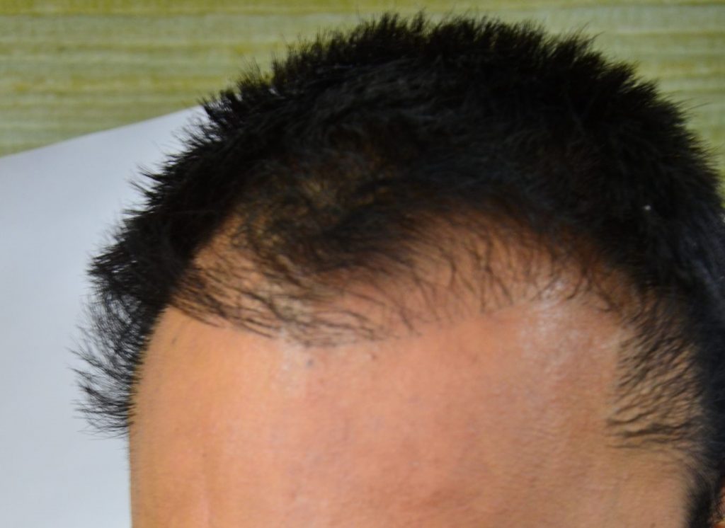 5 Points That Makes A Natural-Looking Hairline for Hair Transplant