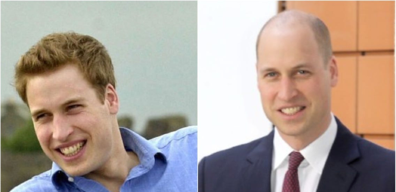 Prince William before and after hairloss
