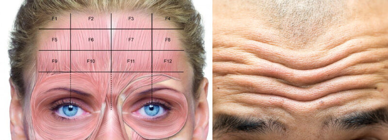 forehead muscles