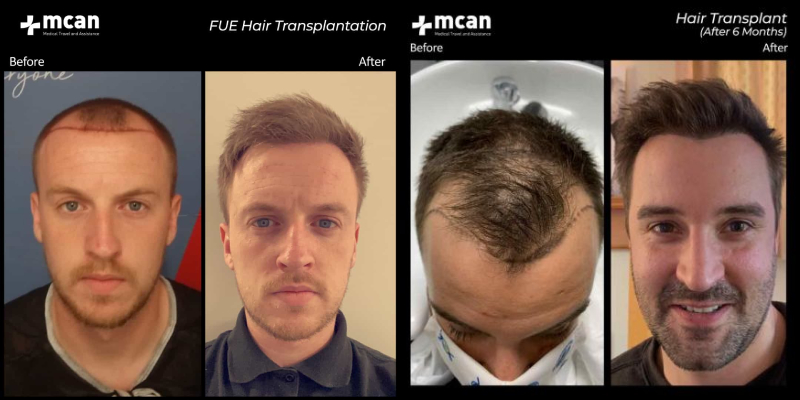 Natürlicher Haaransatz für die Haartransplantation