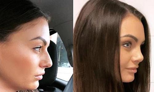 What Is The Perfect Nose Shape Rhinoplasty Mcan Health perfect nose shape rhinoplasty