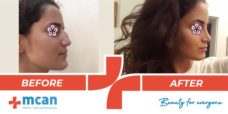 What Is The Perfect Nose Shape Rhinoplasty Mcan Health perfect nose shape rhinoplasty