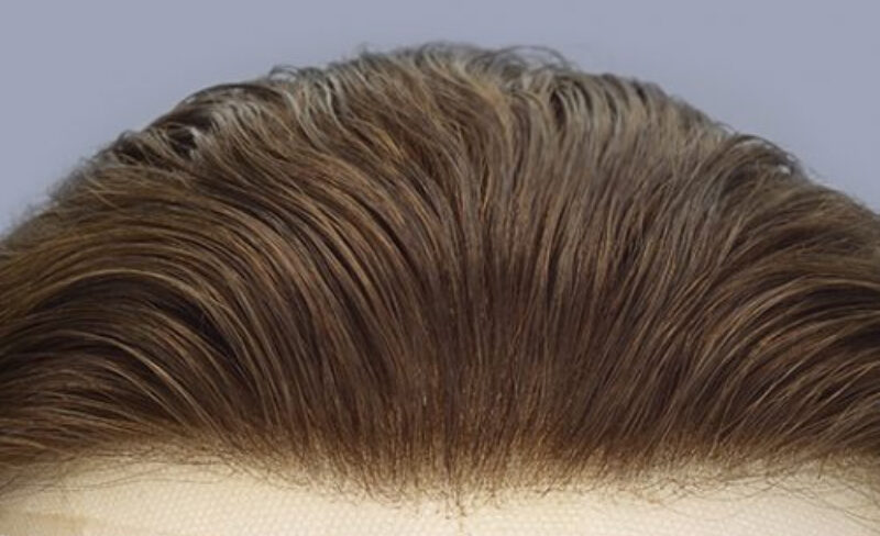 Zig Zag Hairline gives a natural look to your hair after hair transplant