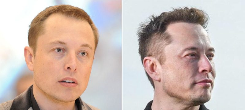 Elon Musk vor und nach der Haartransplantation