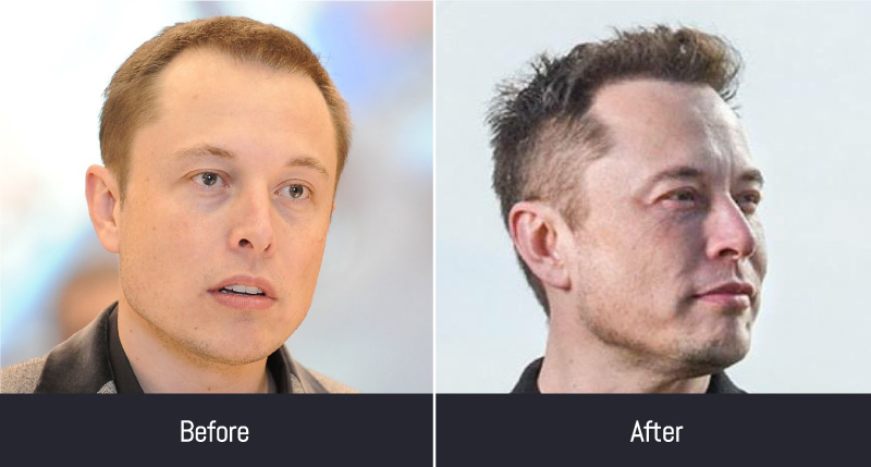 hair transplant celebrities before and after Elon Musk 