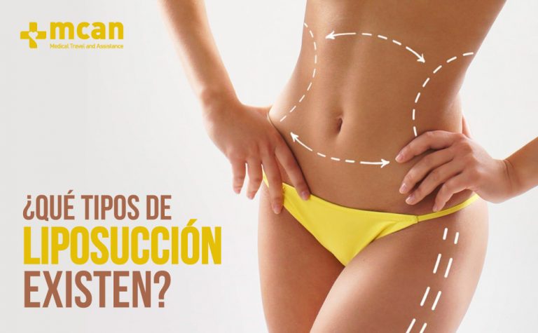 Liposucción en Turquía 83 Que tipos ¿Qué tipos de liposucción existen?