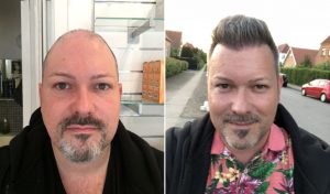 Danish Celebrity Morten Bo Had Hair Transplant in Turkey