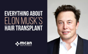 Everything About Elon Musk’s Hair Transplant