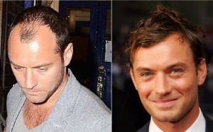 Jude Law Hair Transplant
