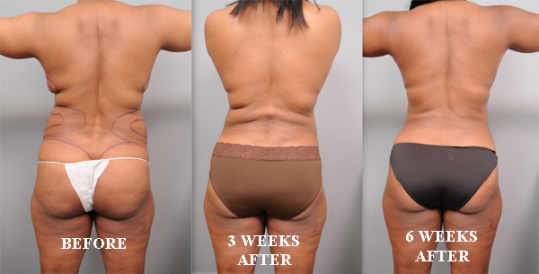 Liposuction Recovery 