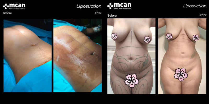 Mcan Health liposuction before and after 