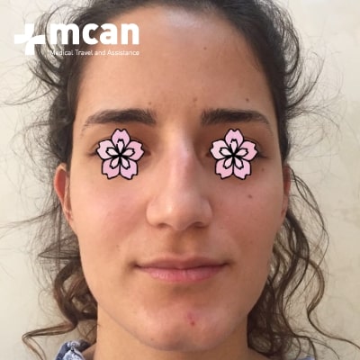 rhinoplasty-nose-job-before-after-2-a rhinoplasty-nose-job-before-after-2-a
