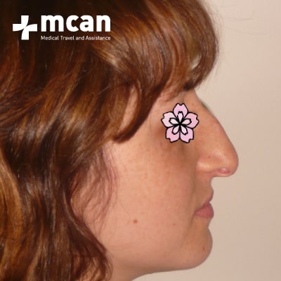 rhinoplasty-nose-job-before-after-3-a rhinoplasty-nose-job-before-after-3-a