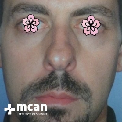 rhinoplasty-nose-job-before-after-4-a rhinoplasty-nose-job-before-after-4-a