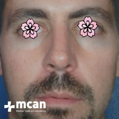 rhinoplasty-nose-job-before-after-4-b rhinoplasty-nose-job-before-after-4-b