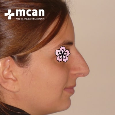 rhinoplasty-nose-job-before-after-5-a rhinoplasty-nose-job-before-after-5-a