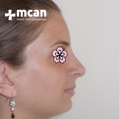 rhinoplasty-nose-job-before-after-5-b rhinoplasty-nose-job-before-after-5-b