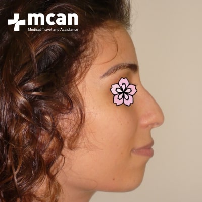 rhinoplasty-nose-job-before-after-6-a rhinoplasty-nose-job-before-after-6-a