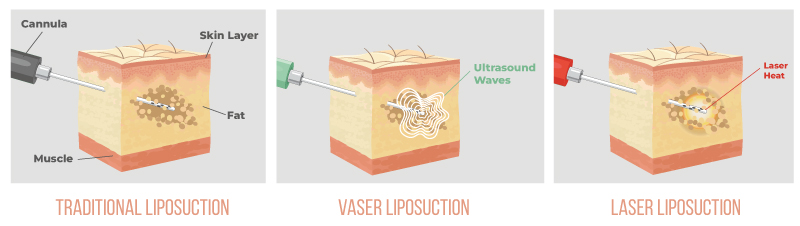 different methods of liposuction