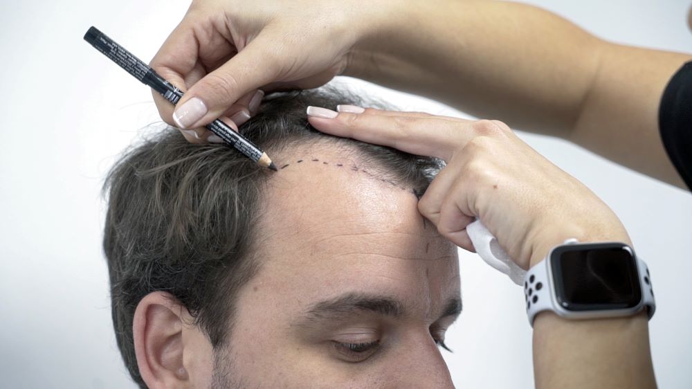 Injerto Capilar Claves