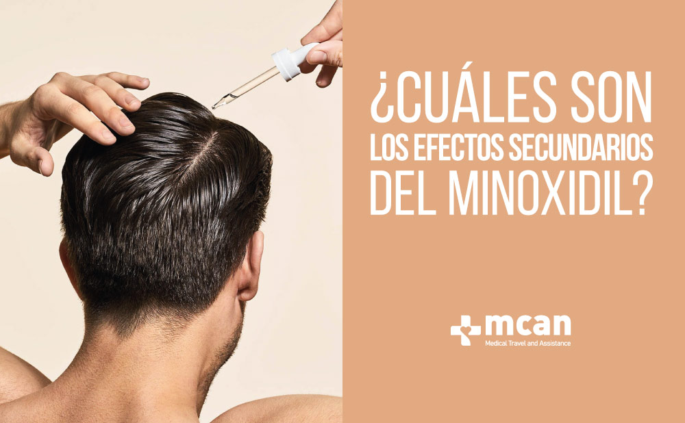 Efectos secundarios del Minoxidil | MCAN Health