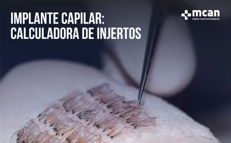 Implante capilar: Calculadora de Injertos 9 Implante capilar calculadora de injertos Implante capilar calculadora de injertos