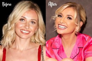 island before surgery teeth amy after