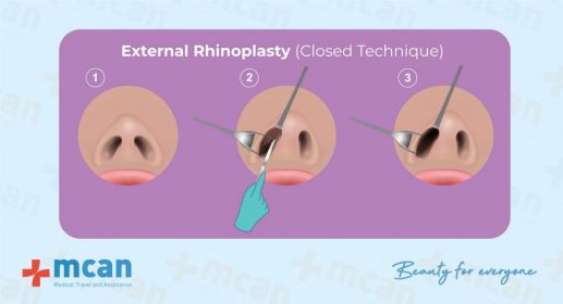 External Rhinoplasty Closed Technique