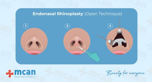 Endonasal Rhinoplasty Open Technique