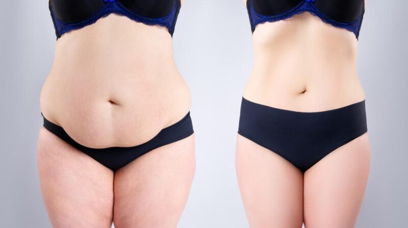 Difference Between Liposuction and Tummy Tuck