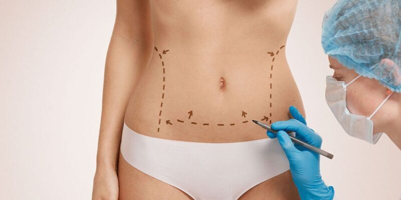 abdominoplasty and liposuction together 