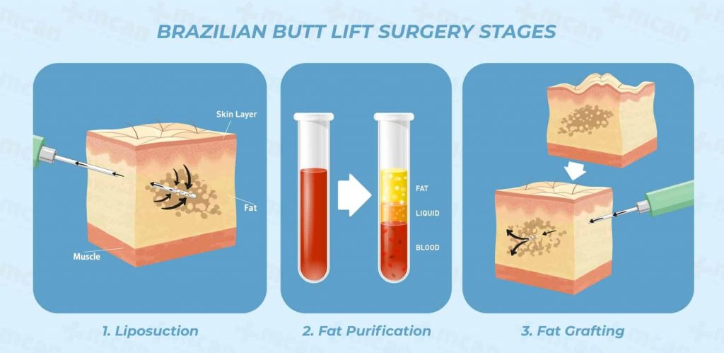 Brazilian Butt Lift In Turkey Butt Augmentation BBL Turkey MCAN 