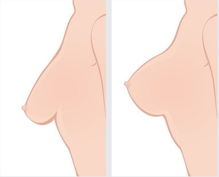breast lift with augmentation before after 