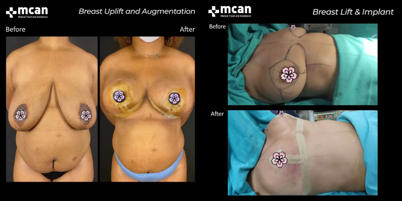 breast lift with implants before and after 