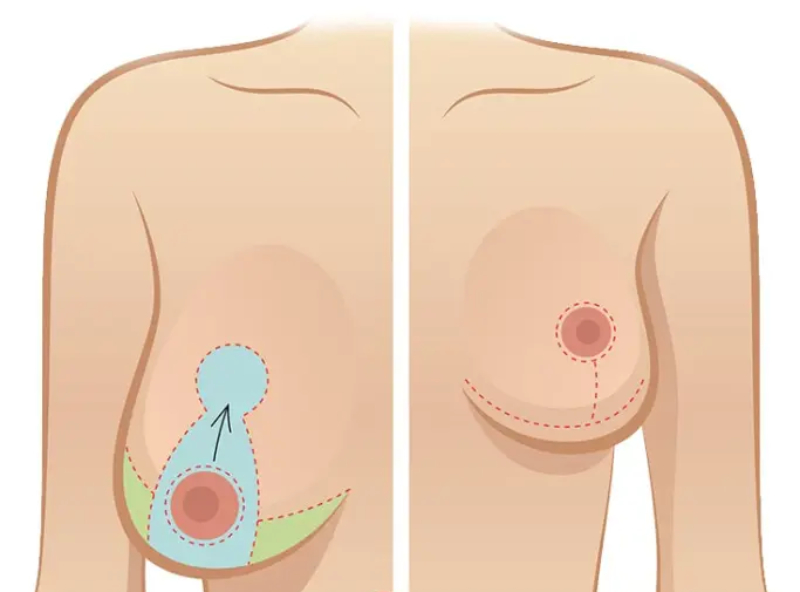 A Combined Breast Lift with Implants Surgery, Yes or No? 4 breast lift without implants breast lift without implants
