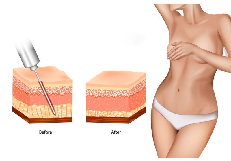 liposuction 360 e1644925549315