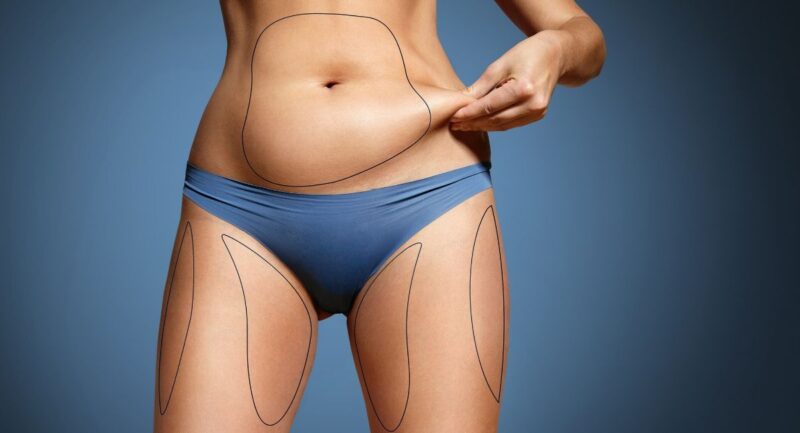 liposuction vs tummy tuck e1644926856258