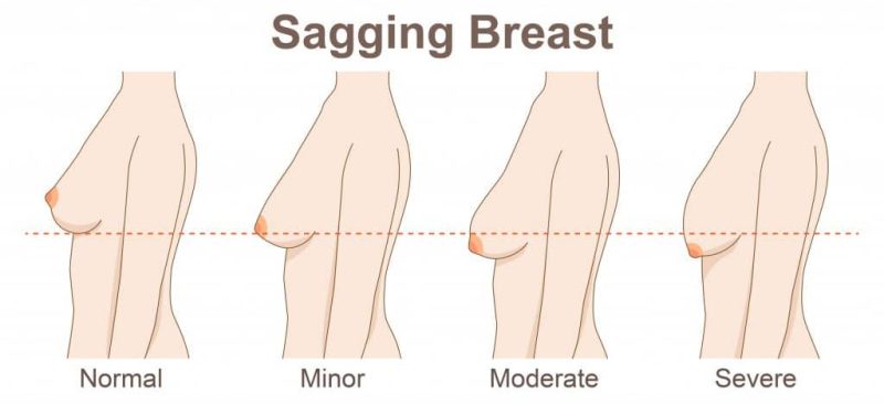 different types of sagging breast