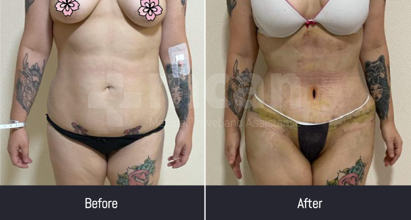 tummy tuck with lipo before and after