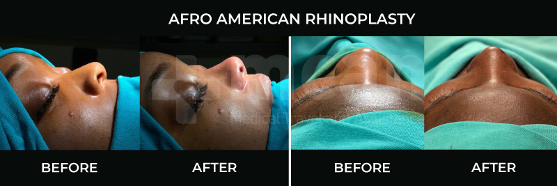 Ethnic African rhinoplasty in Turkey before and after at Mcan Health