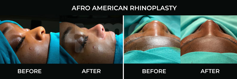Ethnic Rhinoplasty in Turkey: The Big Change With A Small Touch 5 african american ethnic rhinoplasty before after mcan health Ethnic African rhinoplasty in Turkey before and after at Mcan Health