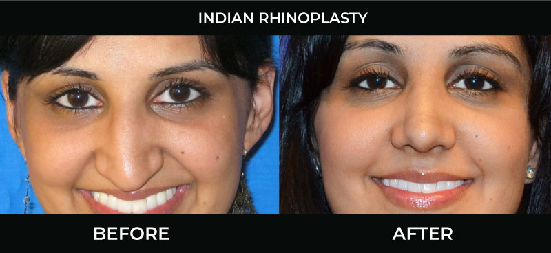 Ethnic Asian rhinoplasty in Turkey before and after