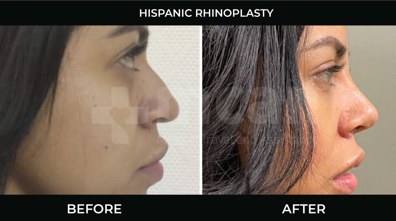Hispanic ethnic rhinoplasty in Turkey before and after at Mcan Health