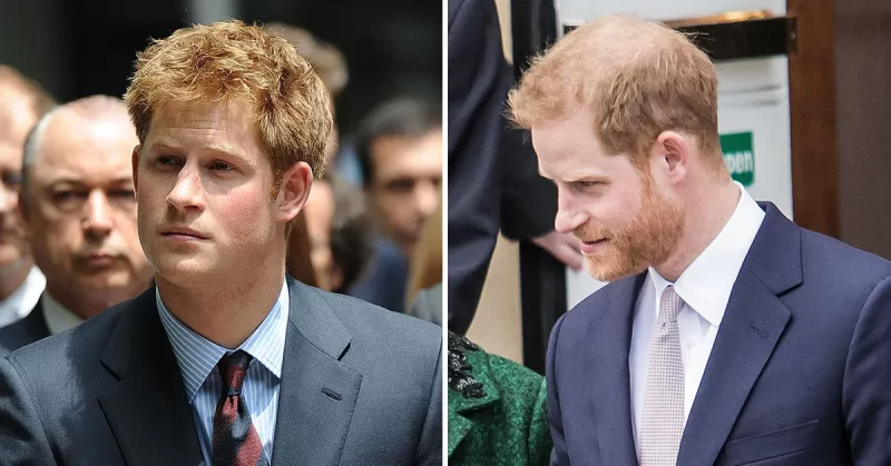 Royal Family Hair Loss and Hair Transplant 5 Prince Hairy Hair transplant e1655992656418 Prince Harry Hair Loss