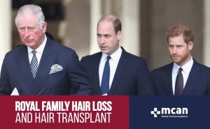 Royal Family Hair Loss and Hair Transplant