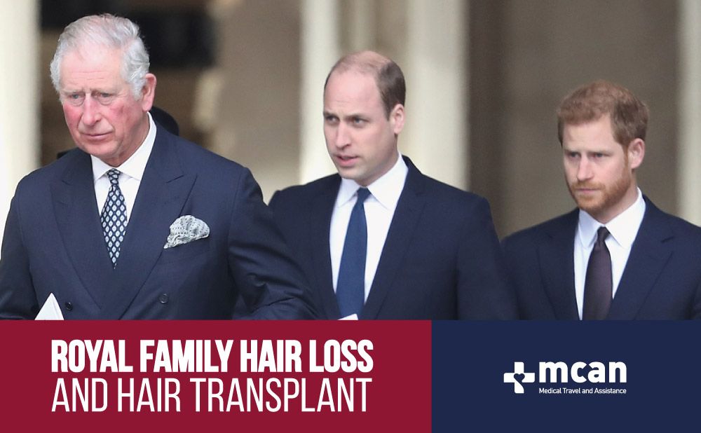 Royal Family Hair Loss and Hair Transplant 3 Royal Family Hair Loss and Hair Transplant Royal Family Hair Loss and Hair Transplant