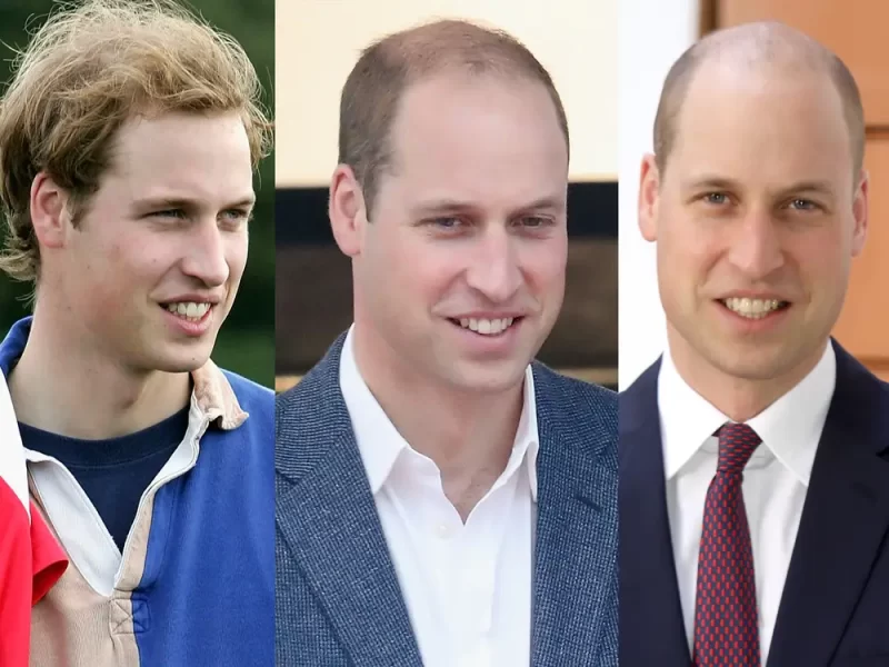 Prince William Hair Loss