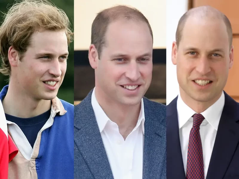 Prince William Hair Loss Prince William Hair Loss